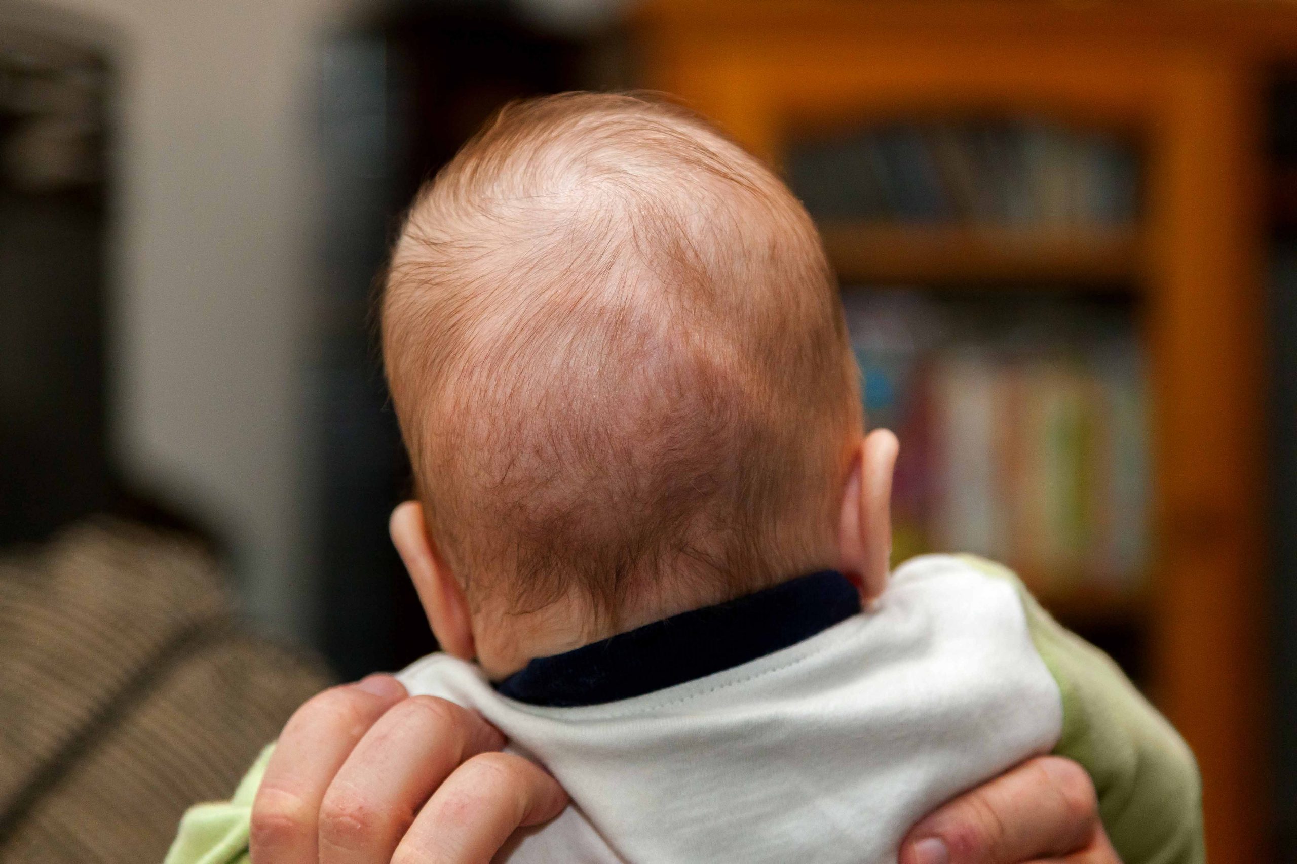 Craniosynostosis-Surgery-2