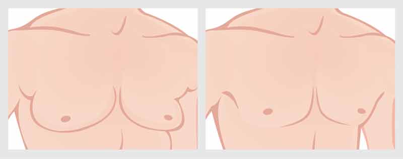Gynecomastia-Before and After Photo
