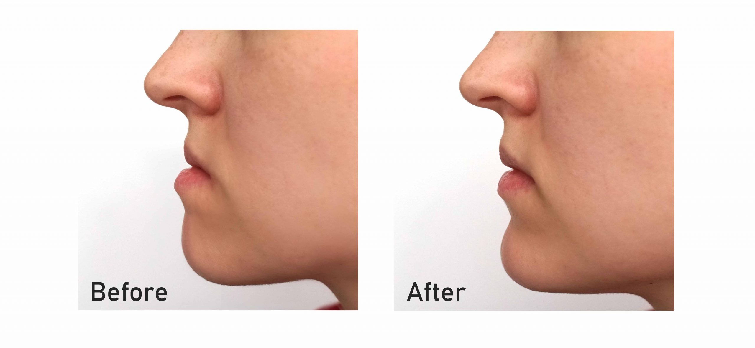 Orthognathic-Surgery-Jaw-Straightening-2