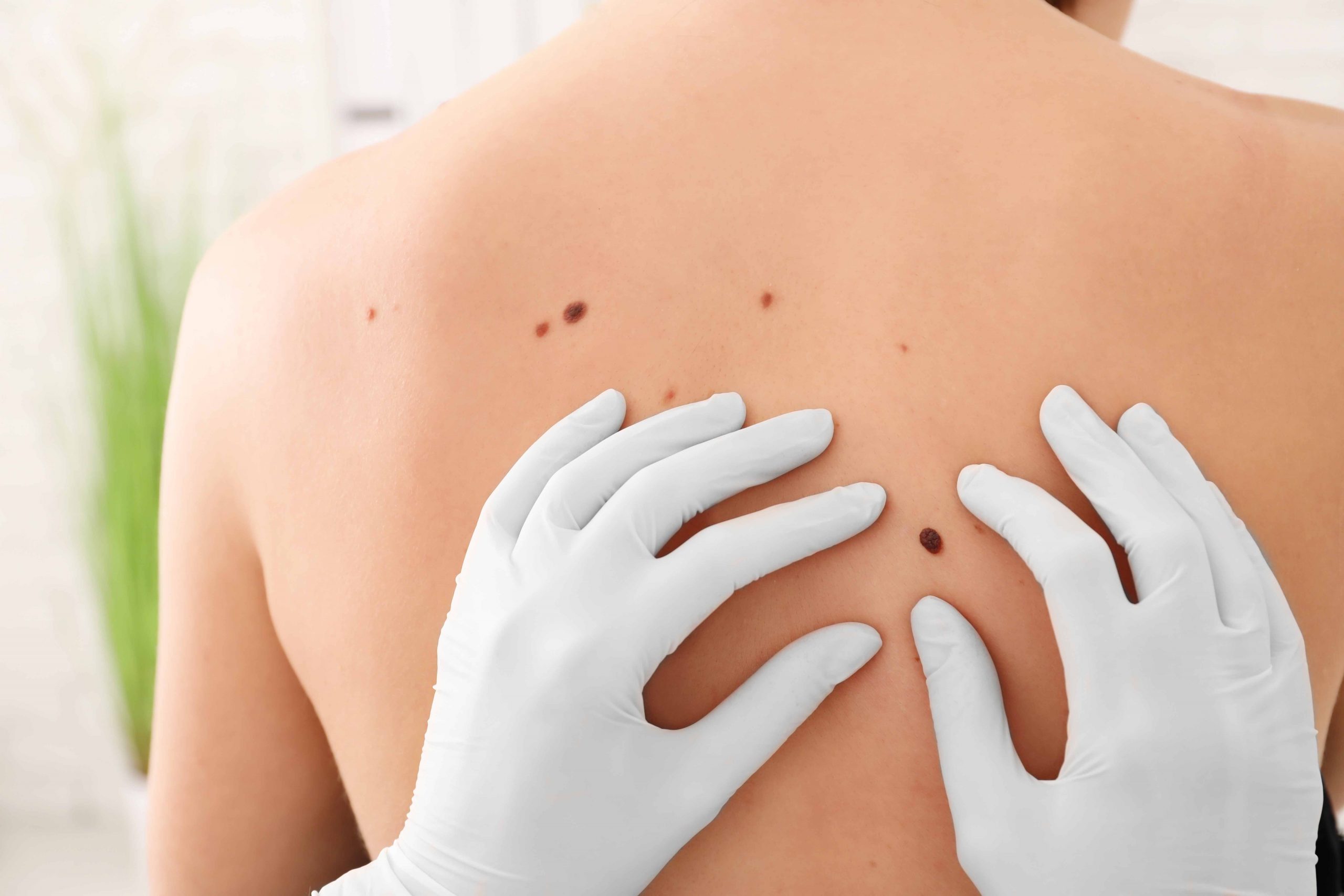 Skin-Cancer-Removal-1