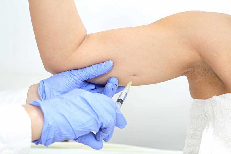 Arm Lift Procedure