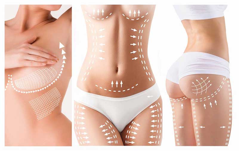 Body Lift Surgery