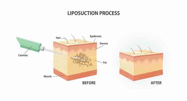 LIPOSUCTION PROCEDURE