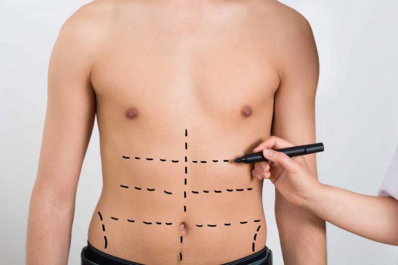 Plastic Surgery for Men