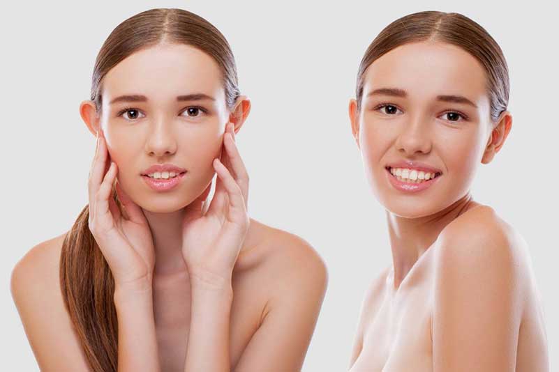 Otoplasty Results
