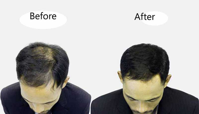 hair transplant fue procedure