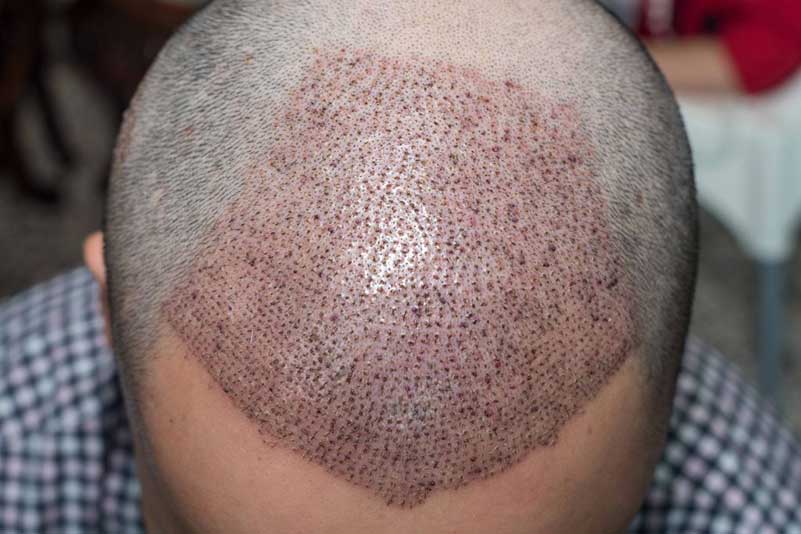 hair transplant post-treatment